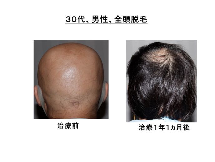 円形脱毛症　病院